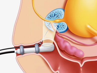 Prostate gland perforation biopsy