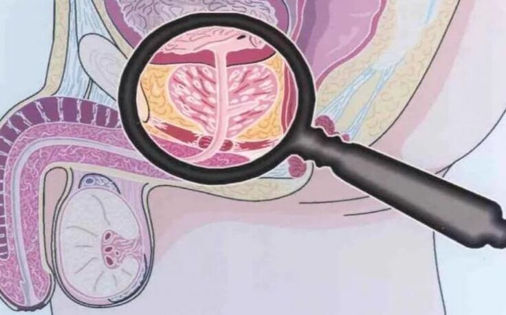 Chronic prostatitis