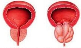 Healthy and fiery prostate
