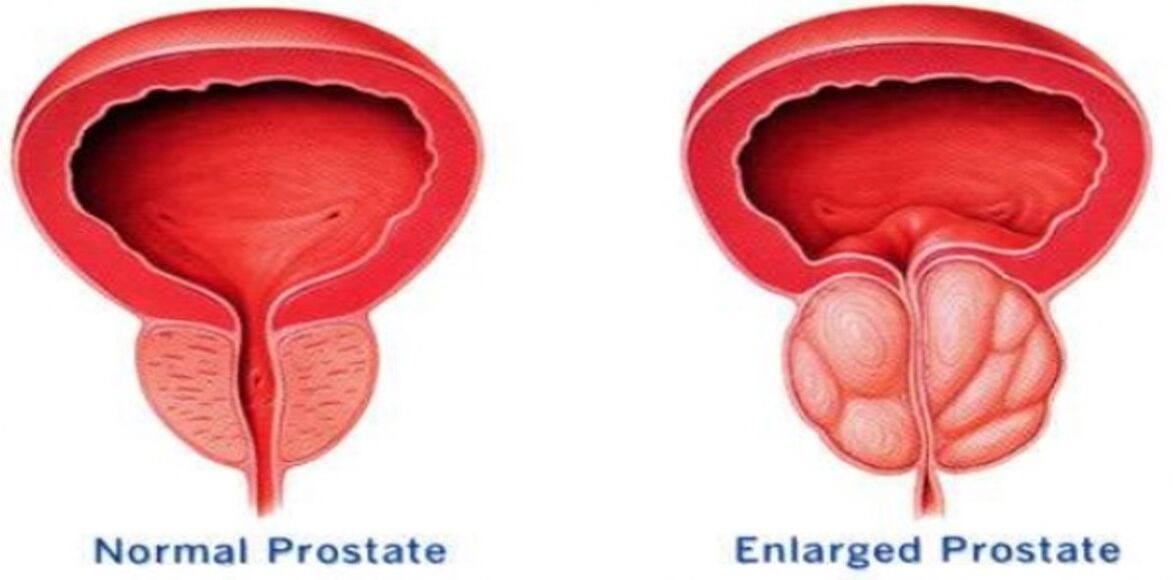 Normal prostate, fiery prostate